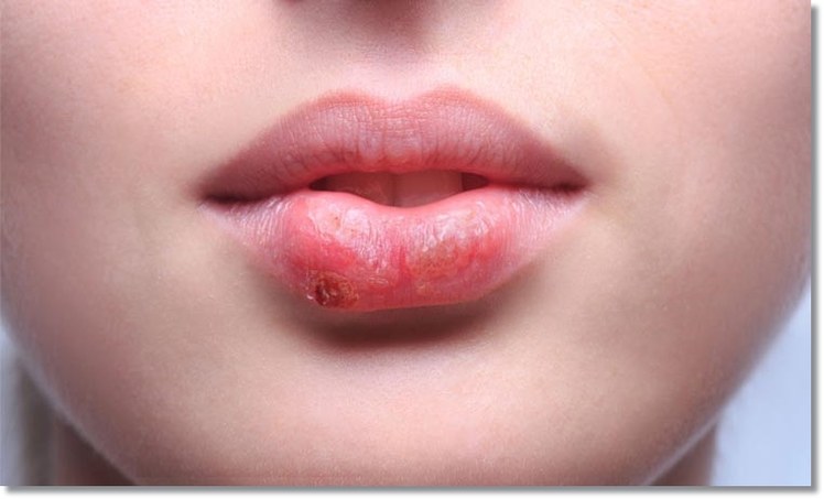 herpes-labial-1.jpg herpes-labial-1.jpg