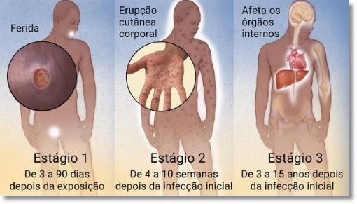 Sífilis: o que é, causas, sintomas, tratamento, diagnóstico e prevenção —  Universidade Federal da Paraíba - UFPB Serviço de Assistência Especializada  Familiar Materno Infantil