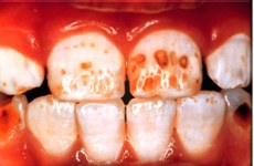 A fluorose dentária consiste em manchas causadas pelo excesso de flúor no esmalte dos dentes e só ocorre durante a formação da dentição, em crianças com idade até sete anos. Foto: Nepibio/UFPB